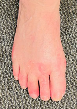 Hammertoe Surgery with Dr. Teichman - After