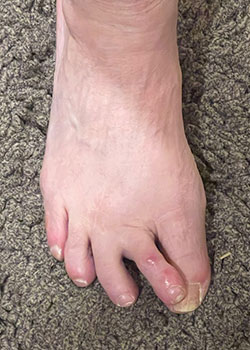 Hammertoe Surgery with Dr. Teichman - Before