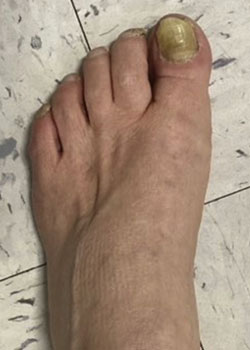 Hammertoe Surgery with Dr. Teichman - After