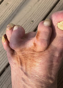 Hammertoe Surgery with Dr. Teichman - Before