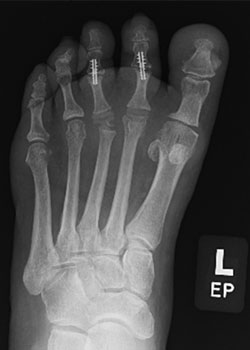 Hammertoe Surgery with Dr. Teichman - After
