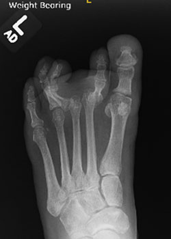 Hammertoe Surgery with Dr. Teichman - Before