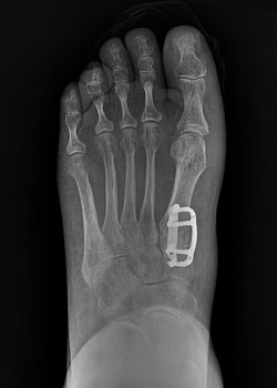 Lapiplasty Bunion Surgery with Dr. Teichman - After