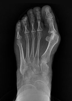 Lapiplasty Bunion Surgery with Dr. Teichman - Before