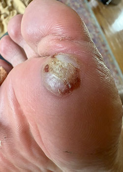 SWIFT Therapy for Plantar Warts with Dr. Rocchio - Before