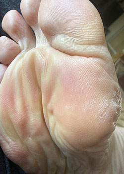 SWIFT Therapy for Plantar Warts with Dr. Rocchio - After
