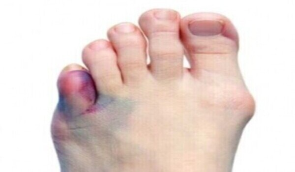 Toe Fractures | Metatarsal Fractures | Broken Toe | Broken Foot in Allentown