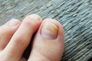 How Is Toenail Fungus Treated?