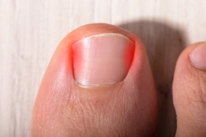 Why Children Develop Ingrown Toenails
