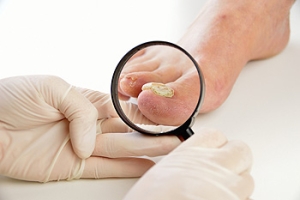 Understanding Fungal Nails
