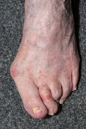 Managing bunions