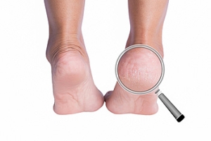 Cracked Heels and Non-Supportive Shoes