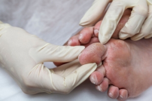 Foot Care Matters When You Have Diabetes