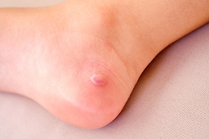 Understanding Foot Blisters and How to Manage Them
