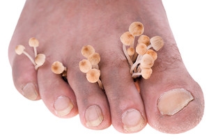 Signs You May Have Toenail Fungus