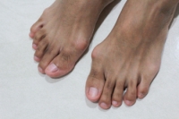 Bunion Causes and Symptoms