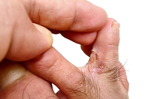 How Footwear Affects Athlete’s Foot