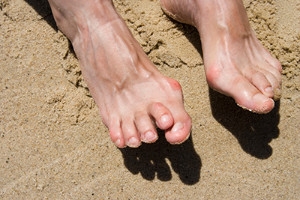 What Caused My Hammertoe?