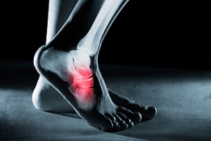 Don&#039;t Ignore a Stress Fracture