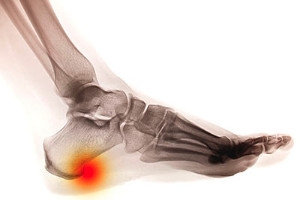 Stretches for Heel Spurs