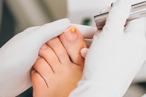 Alternative Treatment for Toenail Fungus