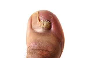 Do I Have Toenail Fungus?