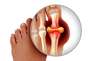 Stages of Gout and the Podiatrist’s Role in Care