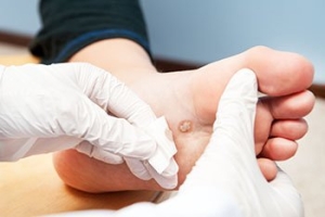 Cryotherapy for Plantar Warts