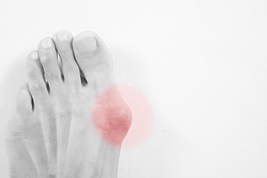 Causes and Symptoms of Bunions
