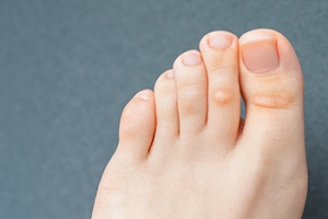 Causes and Symptoms of Corns