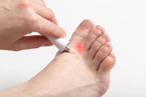 Severe Athlete’s Foot
