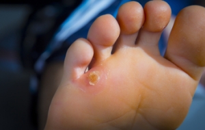 Types of Corns and Calluses