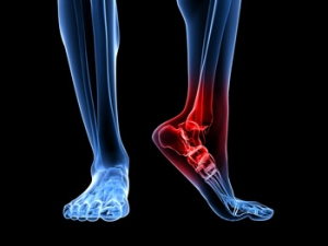 Symptoms of Plantar Fasciitis